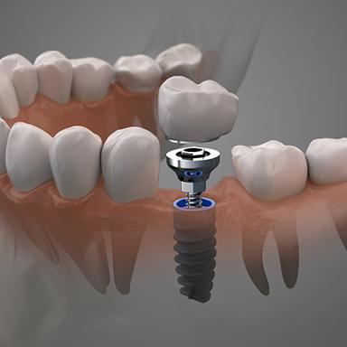 Dental implant in Marco Island, FL receiving crown and abutment