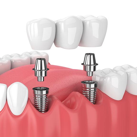 Animated dental bridge replacing a missing tooth