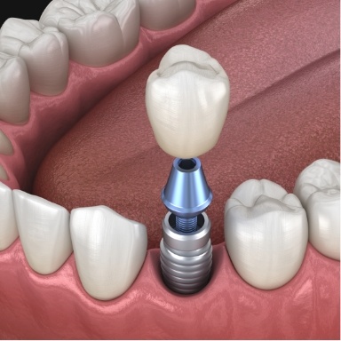 Animated dental implant with dental crown