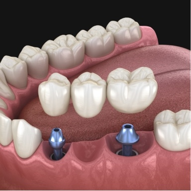 Animated dental bridge supported by two dental implants