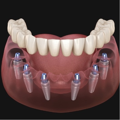 Animated implant denture being supported by six dental implants