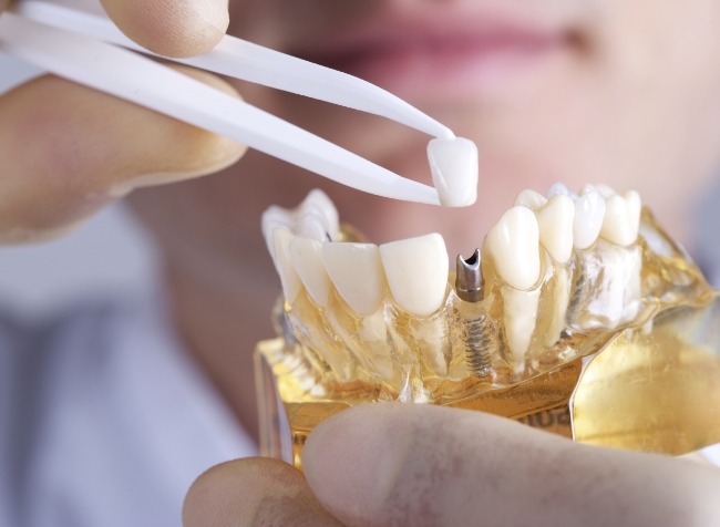 Dentist placing dental crown on model of dental implants in Marco Island